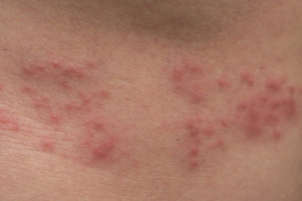 人的背上有带状疱疹。