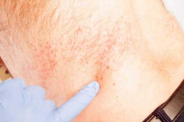 医生指着老人背部的带状疱疹。