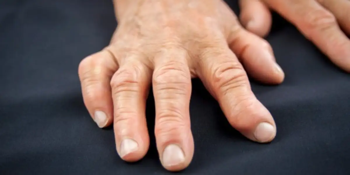 9 Treatments For Arthritis Of The Hands