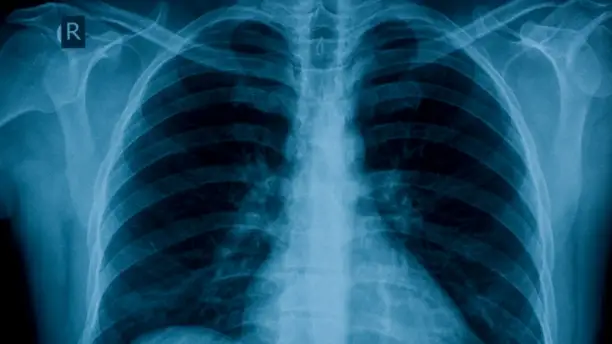 肺部x光慢性阻塞性肺病。
