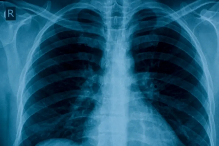 肺部x光慢性阻塞性肺病。