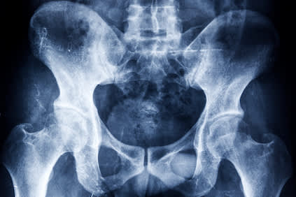 骨盆骨头的X射线