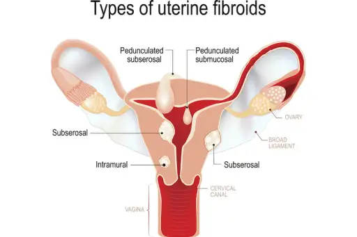 Uterine Fibroids Symptoms Treatments And More