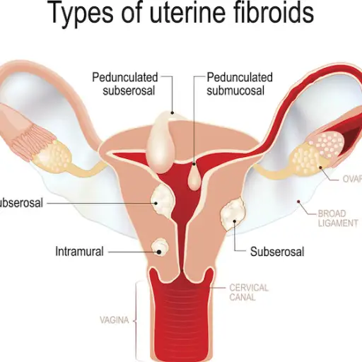 Uterine Fibroids Symptoms Treatments And More