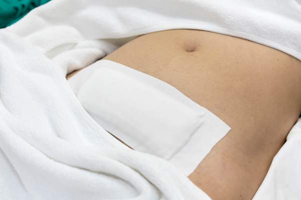 经剖腹子宫肌瘤切除术后