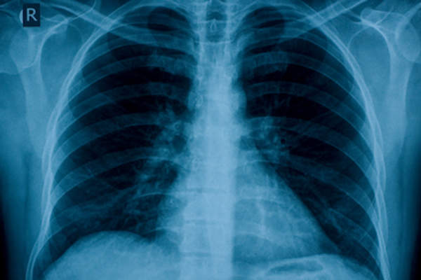 胸部X射线