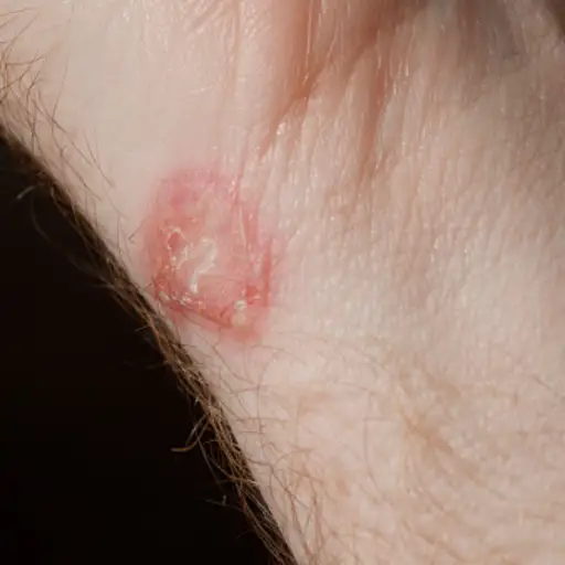 手腕上有湿疹贴。