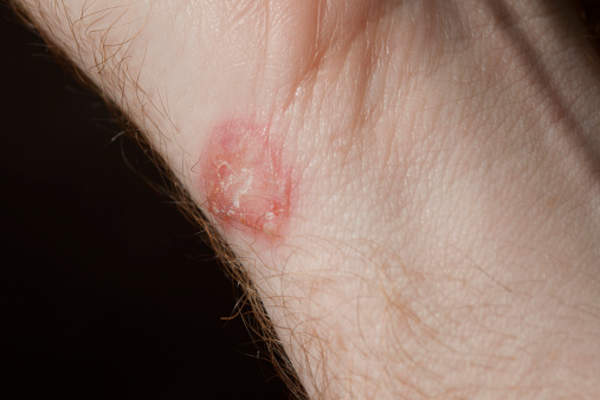 湿疹贴在手腕上。