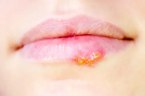 女人嘴唇上长了疱疹。