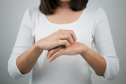 一个女人在她的手上抓痒和发痒的湿疹。