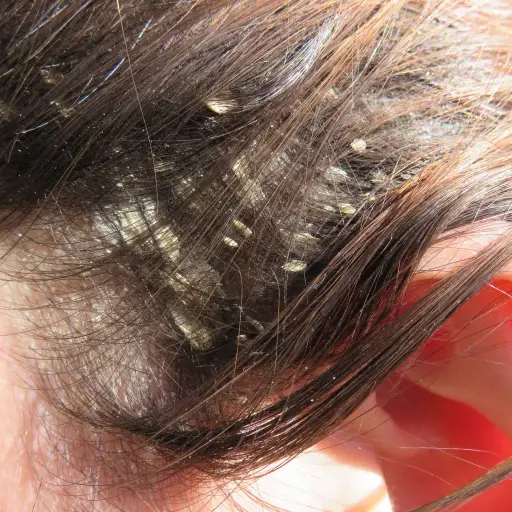 psoriasis flaky scalp)