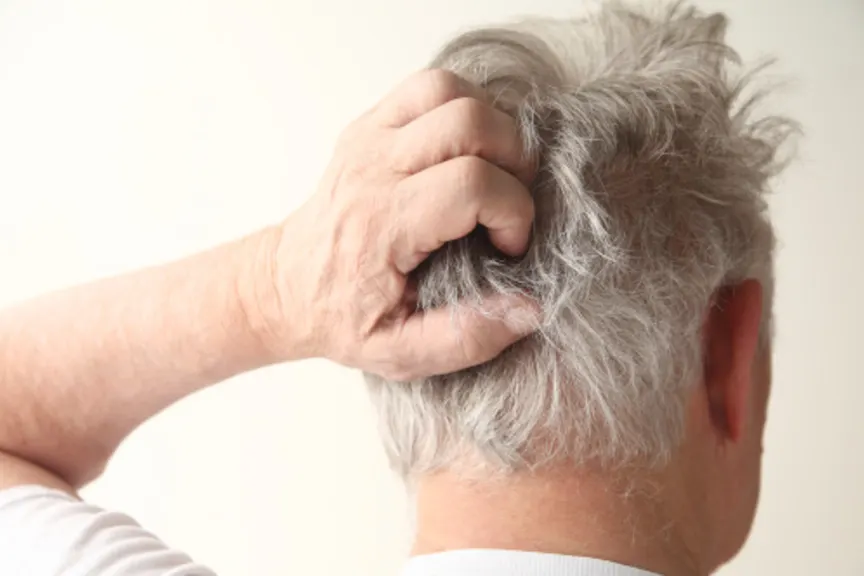scalp psoriasis headache