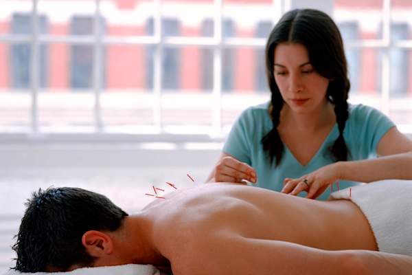 男人接受针灸治疗。