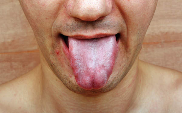 口腔真菌感染。