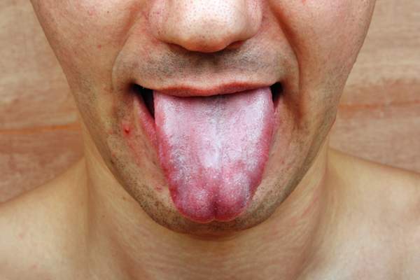 口腔真菌感染。