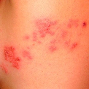 Shingles May Increase Stroke, Heart Attack Risk | HealthCentral