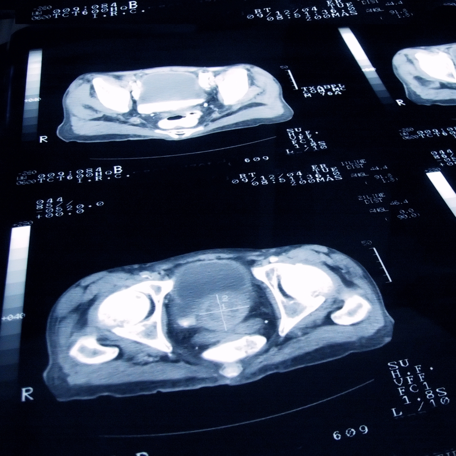 前列腺癌的近距离观察