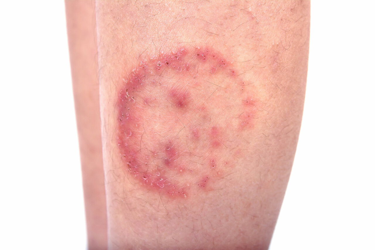 Fungal Infections of the Skin Pamphlet - AAD Shop