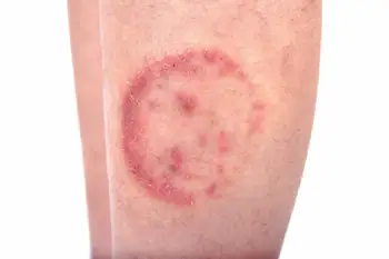 A view of ringworm on a leg