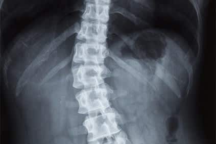 脊柱侧弯脊柱的X射线。
