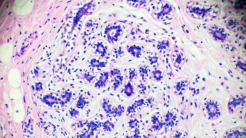 乳腺癌细胞。