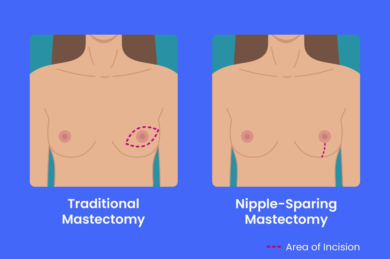 What Is a Nipple-Sparing Mastectomy?