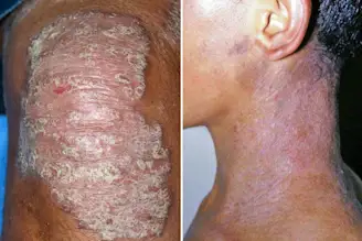 Left: Psoriasis on knee; Right: Eczema on neck