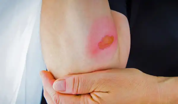 Steam Burns: Symptoms, Treatment, and Prevention