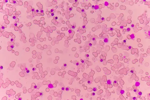 贫血患者的血液涂片在显微镜下
