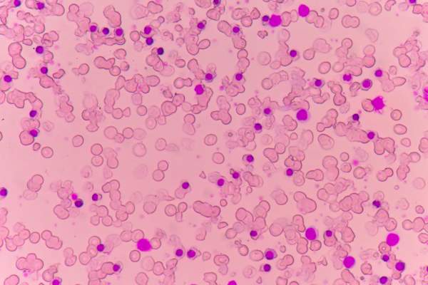 显微镜下贫血患者的血涂片