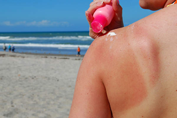 人在海边晒伤。
