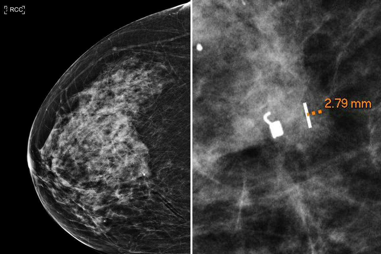 Titanium Markers for Breast Biopsy: Uses and Side Effects