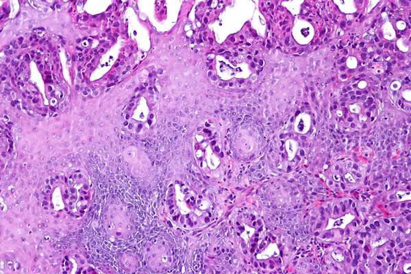 活检。食道的粘膜内腺癌表示管状腺体浸润固有层和鳞状上皮