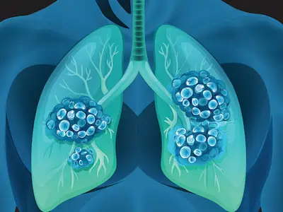 肺癌插图。