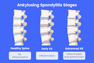 Ankylosing Spondylitis Patient