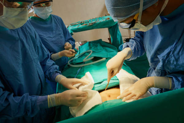 医生进行胃切除术。