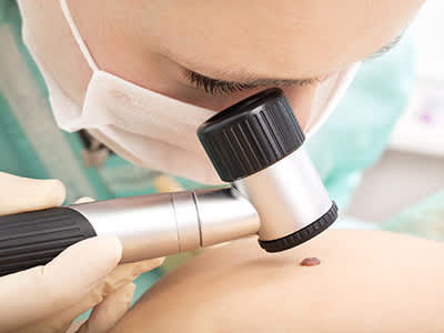 皮肤科专家研究胎记使用皮肤镜。