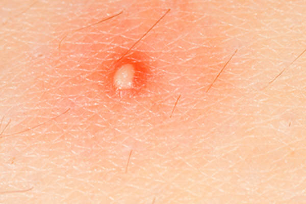 皮肤上有疖子。