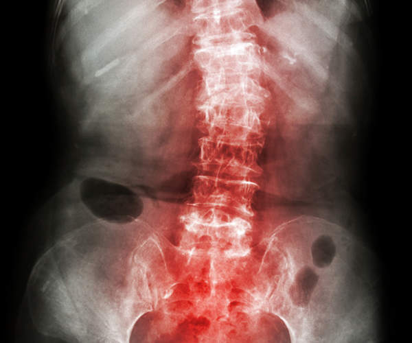 脊柱上突出的X射线。