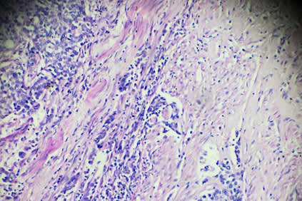 膀胱移行细胞癌显微镜下观察。