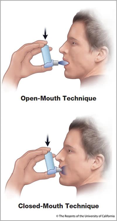 是您在使用吸入器正确-1