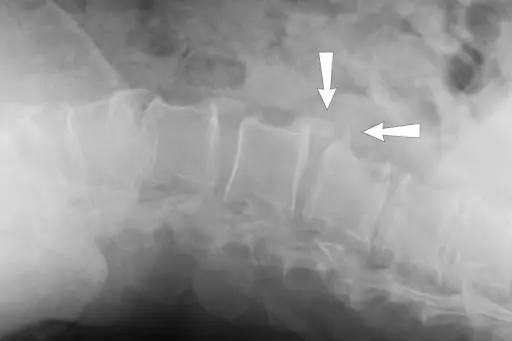 腰椎脊柱脊柱脊柱病的横向X射线