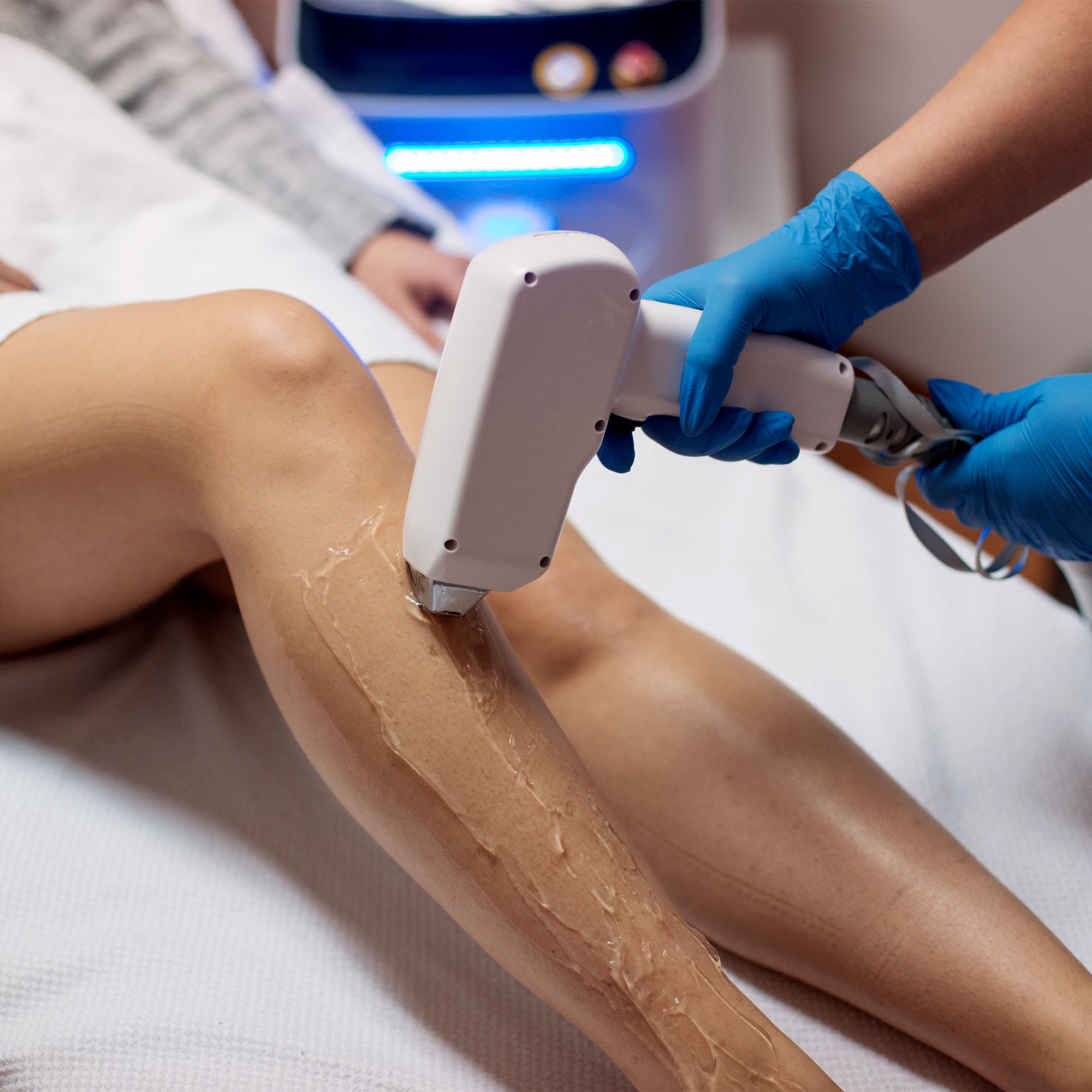 一名妇女接受激光脱毛