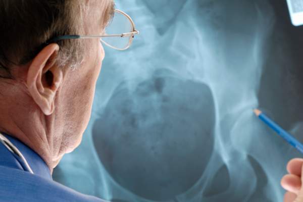 医生检查的X射线骨质疏松