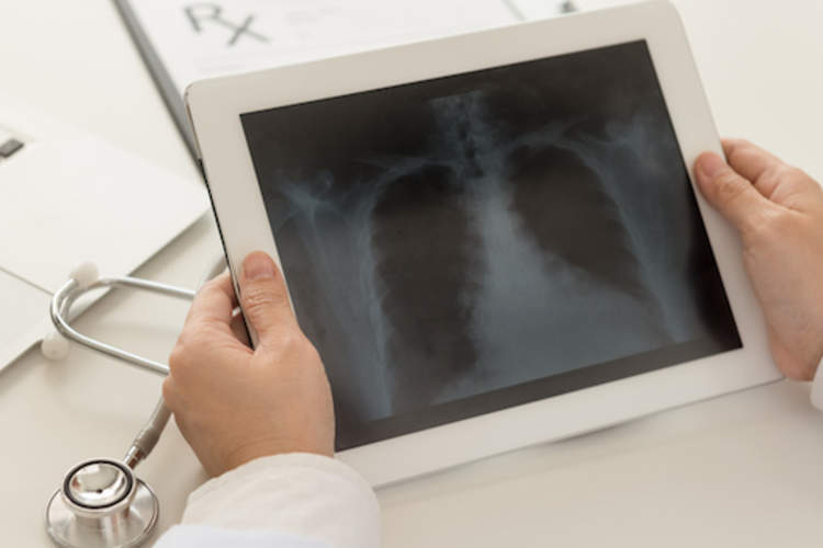 医生正在查看平板肺扫描。