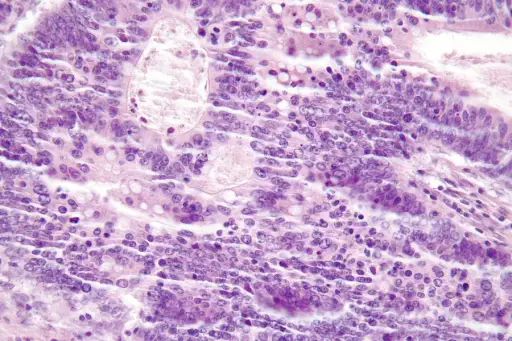 肿瘤浸润淋巴细胞的显微照片，见Lynch综合征