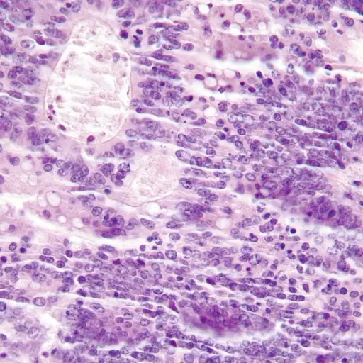 Lynch综合征中肿瘤浸润淋巴细胞的显微照片