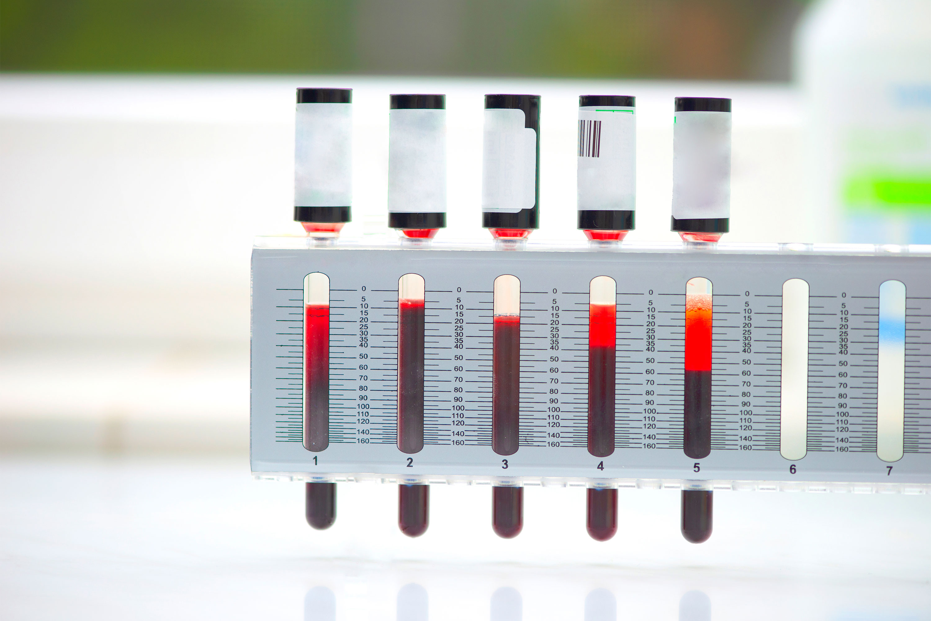 What Is A Normal Sed Rate For Rheumatoid Arthritis