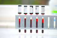 What Is A Normal Sed Rate For Rheumatoid Arthritis 