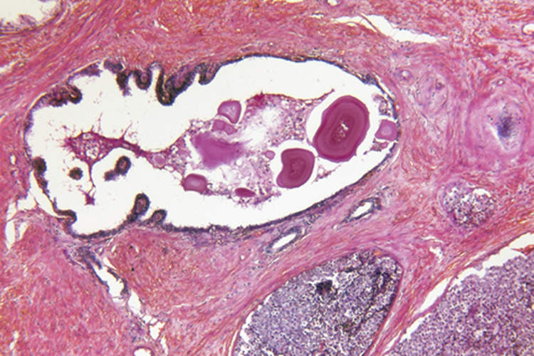 前列腺癌细胞。